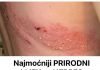 Najmoćniji PRIRODNI LIJEK za HERPES ZOSTER: uklonite ga zauvijek!