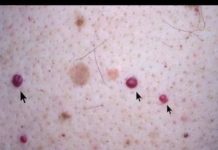 IMATE LI OVE CRVENE TAČKICE NA TIJELU? To nisu popucali kapilari, EVO O ČEMU SE ZAISTA RADI